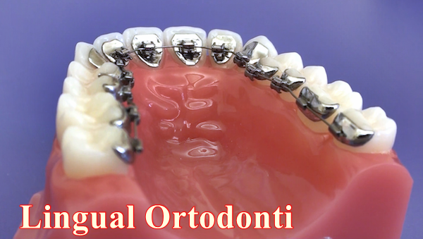 Lingual Ortodonti Tedavisi Nedir.?