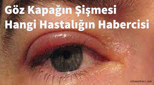 Göz Kapağın Şişmesi Hangi Hastalığın Habercisi?