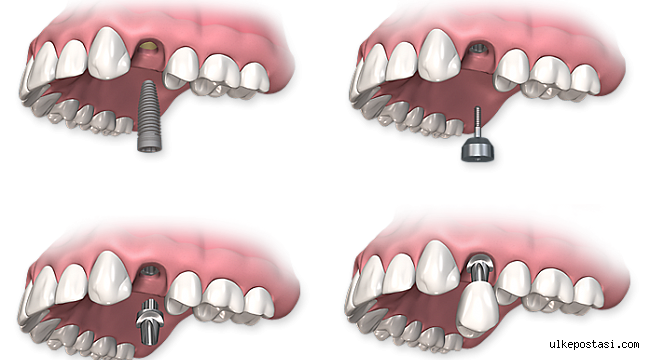 İMPLANT DİŞ?